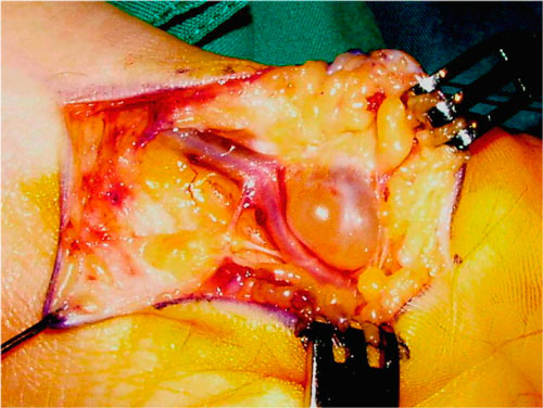 Ganglión en el canal de Guyon