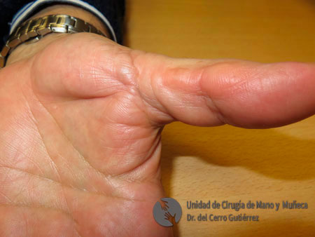 Enfermedad de Dupuytren. Afectación del primer dedo.