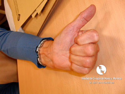 Resultados de la cirugía del Dupuytren
