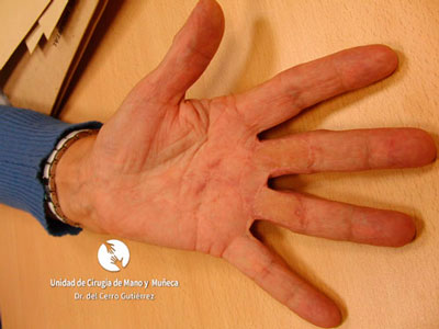 Postcirugía de la patología del Dupuytren