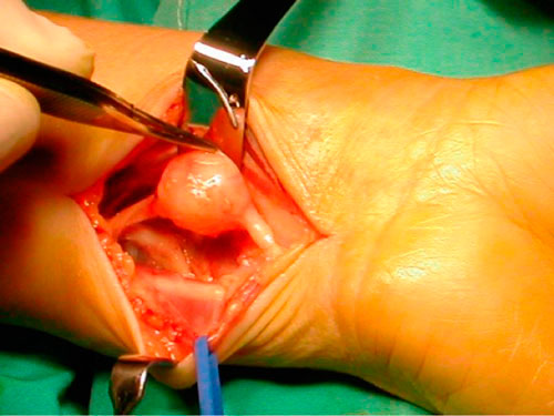 Neurinoma del nervio cubital.