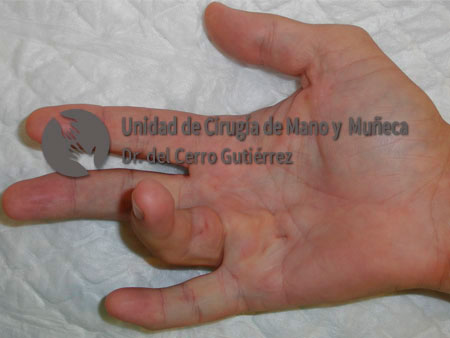 Enfermedad de Dupuytren. Afectación del cuarto dedo.