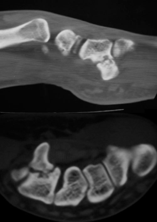 Radiografía de Fractura de la apófisis unciforme del hueso ganchoso