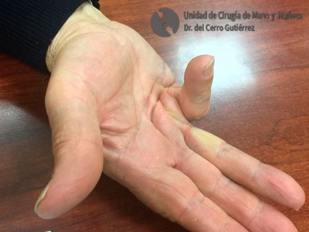 Enfermedad de Dupuytren. Afectación GRAVE del quinto dedo.