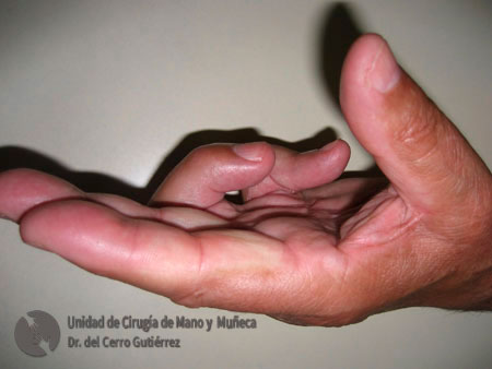 Enfermedad de Dupuytren. Afectación GRAVE quinto dedo lateral.