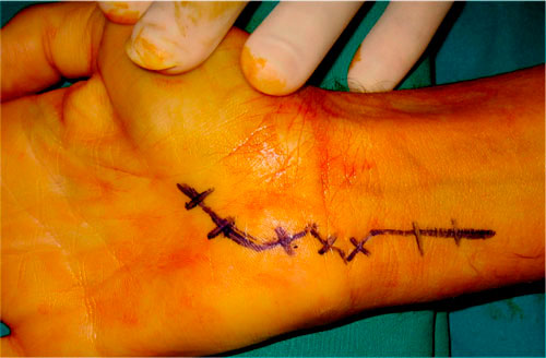 Incisión de abordaje al canal de Guyon.