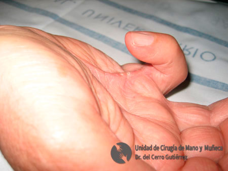 Enfermedad de Dupuytren. Afectación del quinto dedo.
