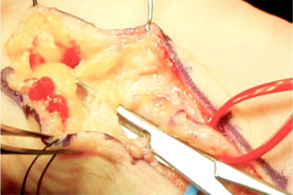 liberación a nivel proximal en la liberación del canal de Guyon