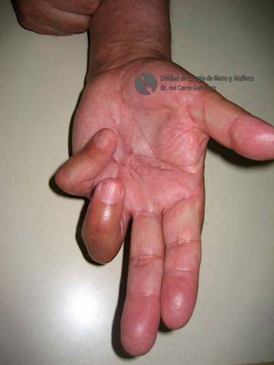 Enfermedad de Dupuytren. Afectación GRAVE cuarto y quinto dedo de la mano.