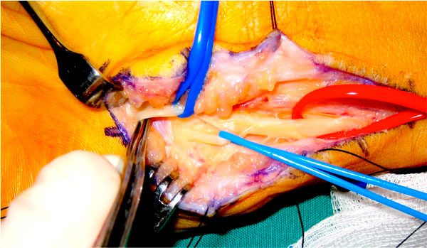 cirugía del canal de Guyon: disección a nivel distal de las ramas del nervio cubital