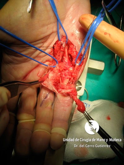 Cirugía de la patología del Dupuytren