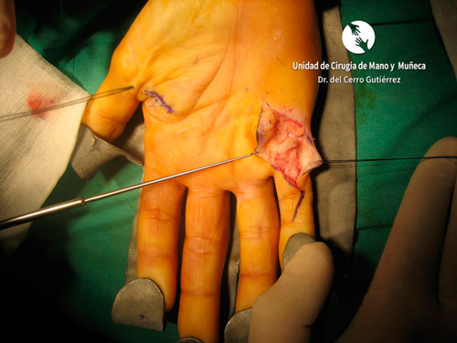 3 técnicas quirúrgicas para tratar la enfermedad de Dupuytren