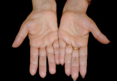 Atrofia de la musculatura del pulgar en el síndrome del túnel del carpo