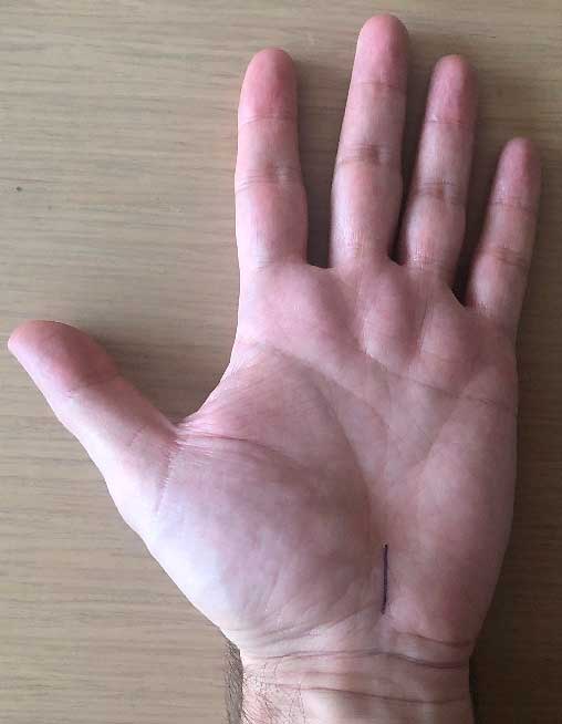 Cirugía del síndrome del túnel del carpo