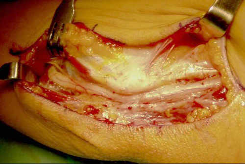 Comprobación en flexión de la ausencia de subluxación del nervio cubital del codo