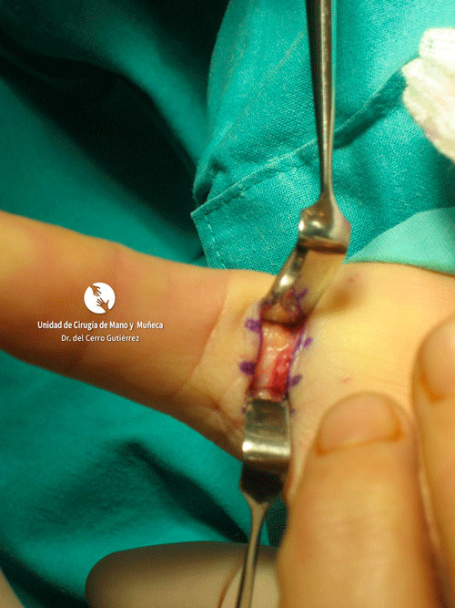 Dedo en Resorte VISUALIZACION POLEA