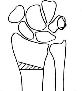 Enfermedad de Kienbock 11