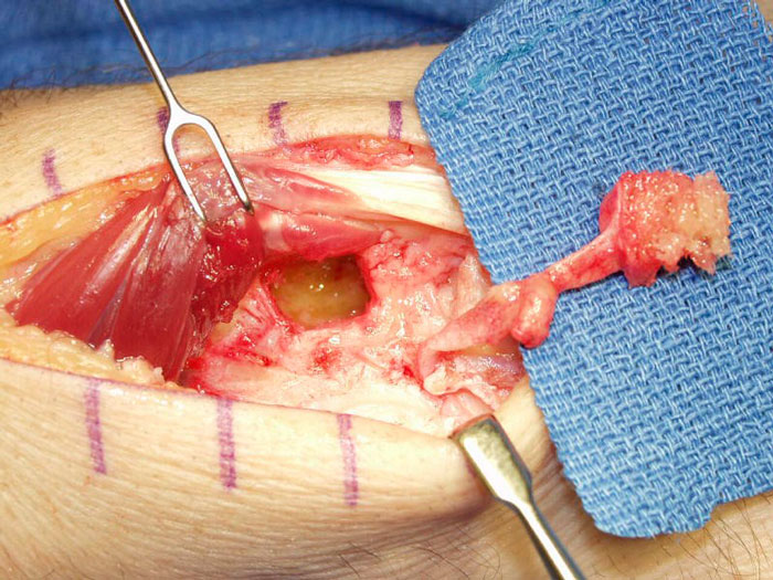 Enfermedad de Kienbock 12