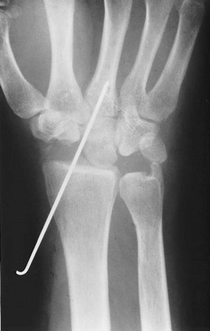 Enfermedad de Kienbock 14