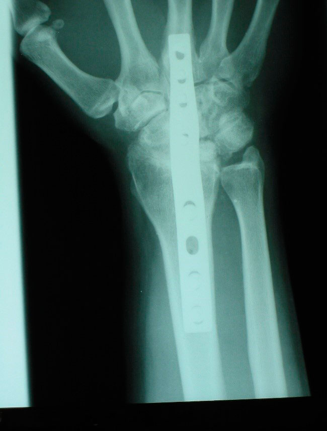 Enfermedad de Kienbock 15