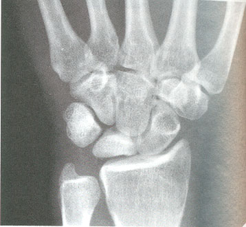 Enfermedad de Kienbock 2