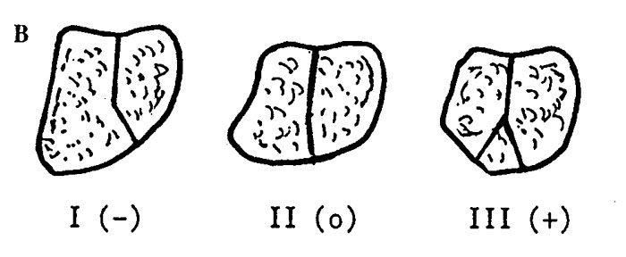 Enfermedad de Kienbock 3