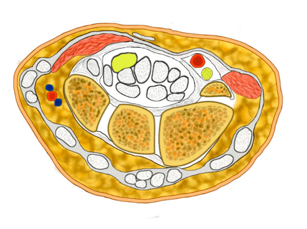 El síndrome del Canal de Guyon es la compresión del nervio cubital