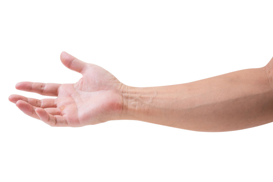 Síndrome del Canal de Guyon