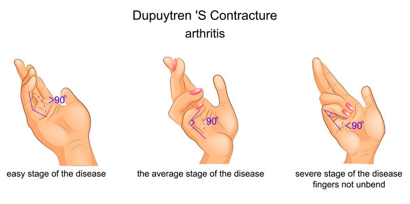 Grados de contractura en la patología del Dupuytren