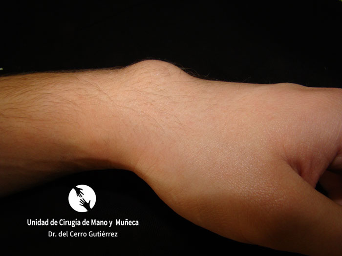 Imagen de un ganglión dorsal de la muñeca
