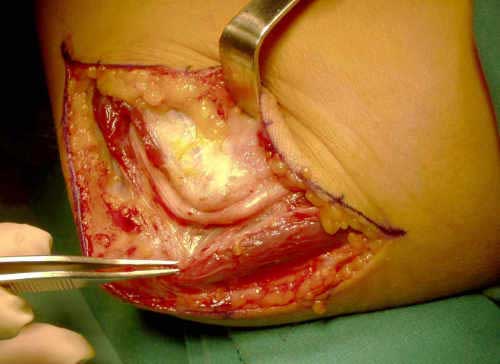 Liberación in situ del nervio cubital del codo