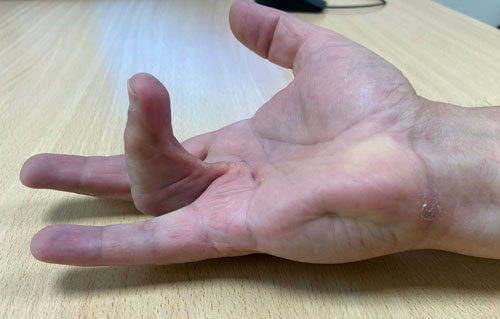 Paciente con Dupuytren