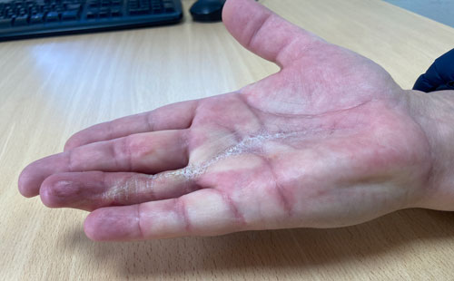 Resultados cirugía del Dupuytren