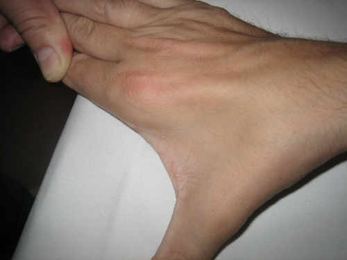 Síndrome del Túnel Cubital atrofia de la musculatura