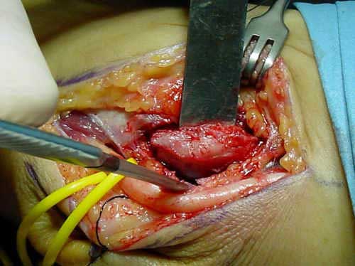 Síndrome del Túnel Cubital mínima resección de la epitróclea