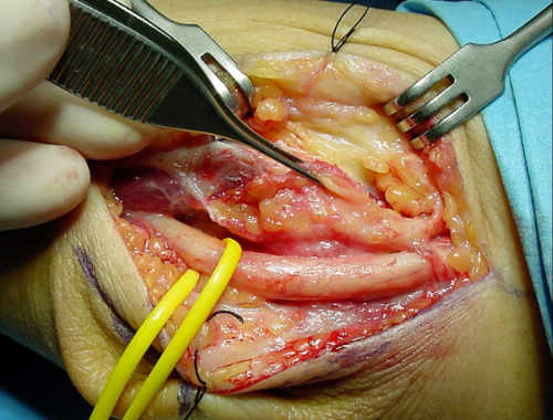 epitrocleoplastia con fascia en el síndrome del túnel cubital