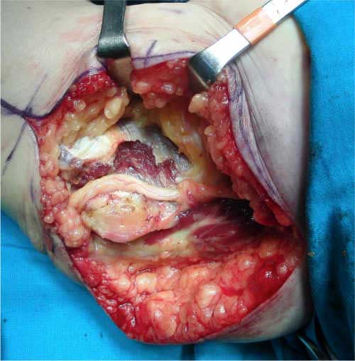 liberación submuscular en la cirugía del síndrome del túnel cubital del codo