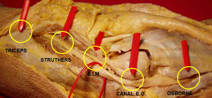 posibles zonas de compresión del nervio cubital en codo