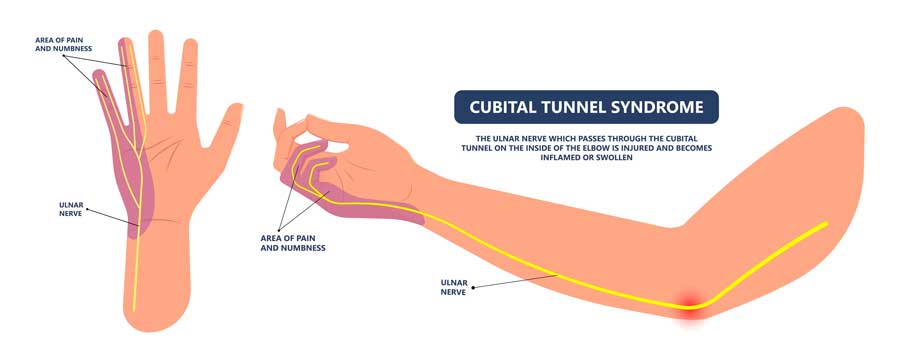 sindrome del túnel cubital