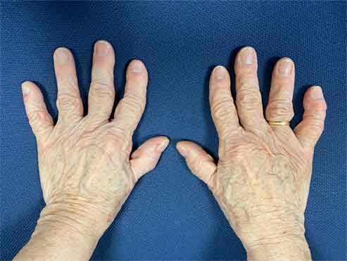 artrosis y mano degenerativa