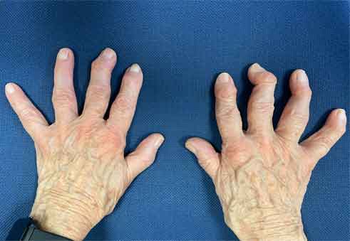 artrosis y mano en la tercera edad