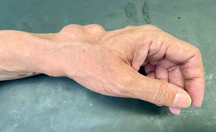 tumores benignos y malignos de la mano y muñeca